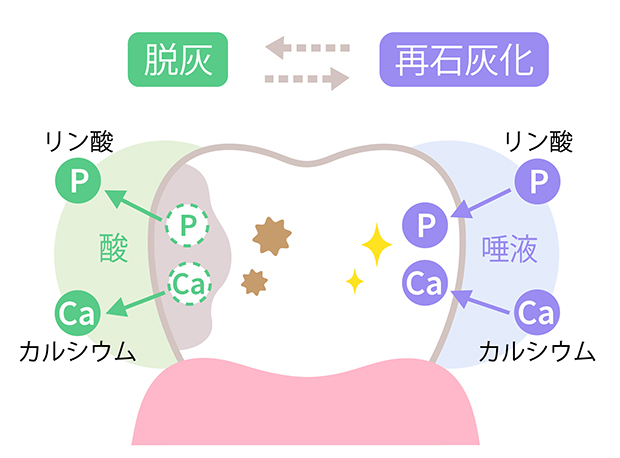 むし歯はどうしてなるの?